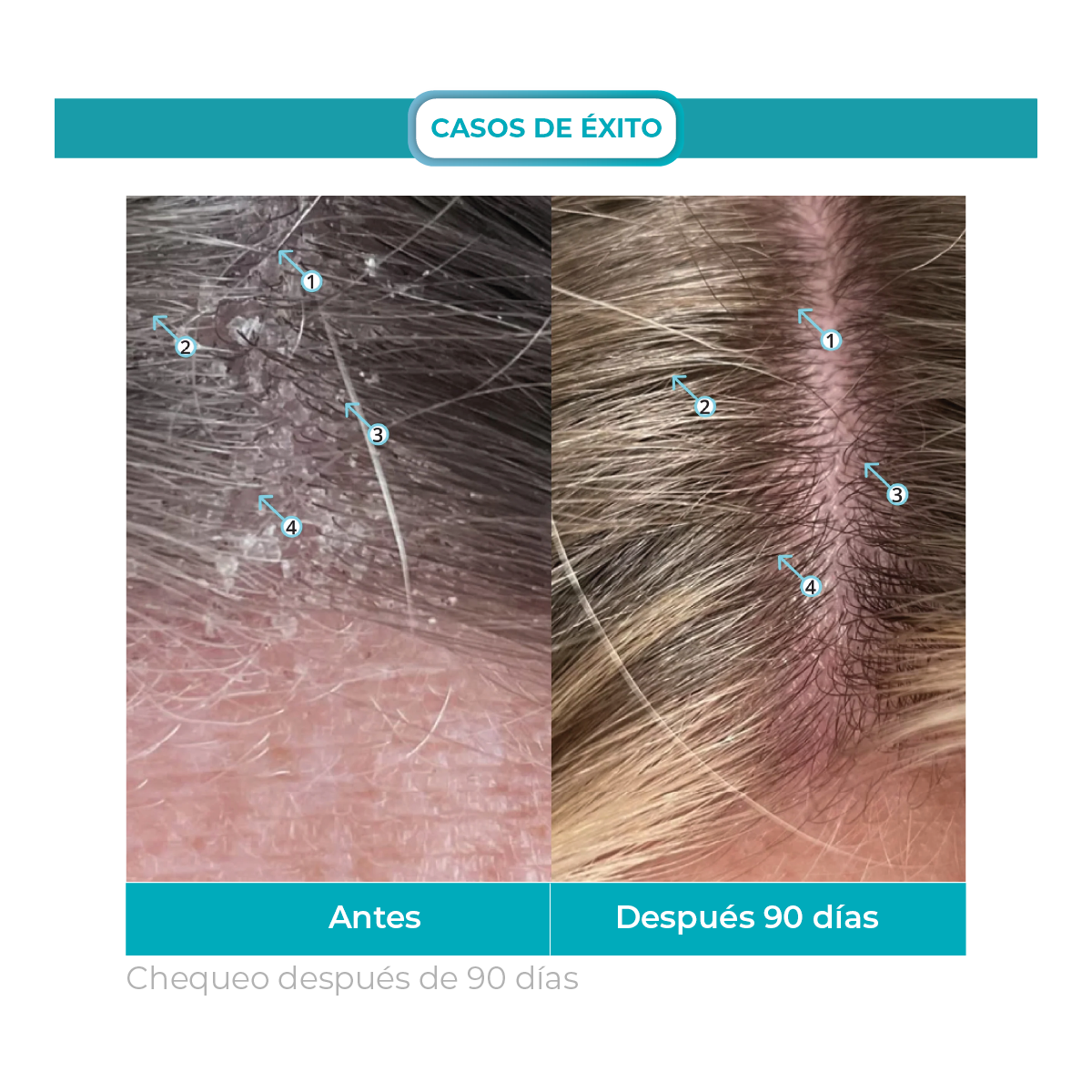 Dandrene® | Shampoo Exfoliante Anti-Caspa